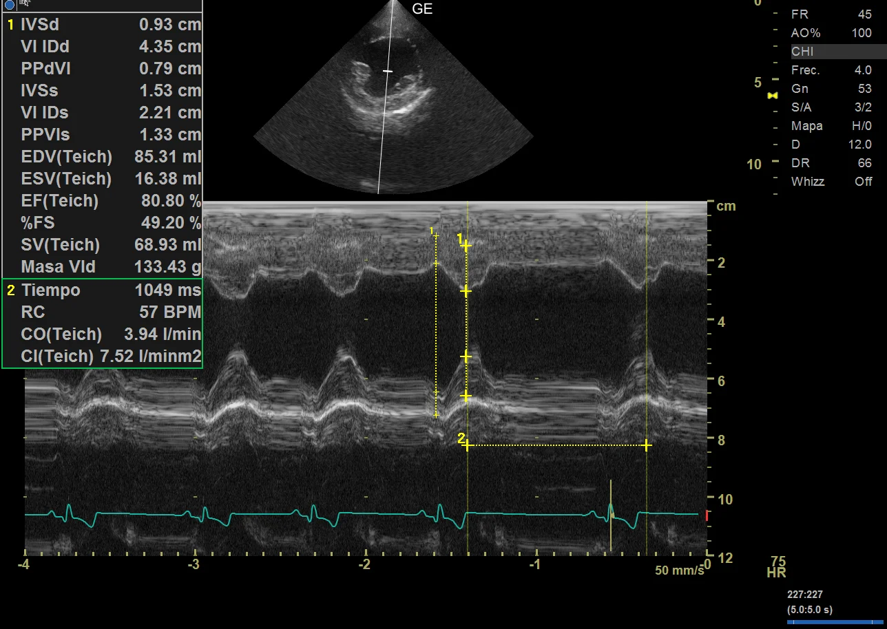 Ecocardiografía en modo M con las mediciones de las paredes y cavidades del corazón